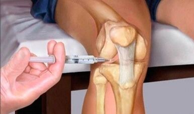 Ácido hialurónico con artrosis de la articulación de la rodilla