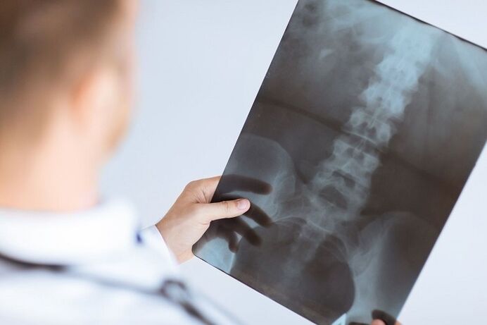 Opciones de diagnóstico para osteocondrosis lumbar