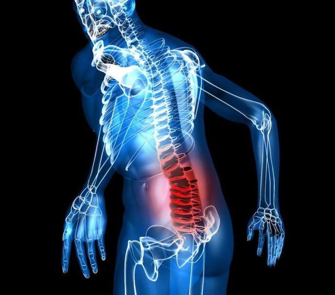 etapas de grado y desarrollo de la osteocondrosis lumbar