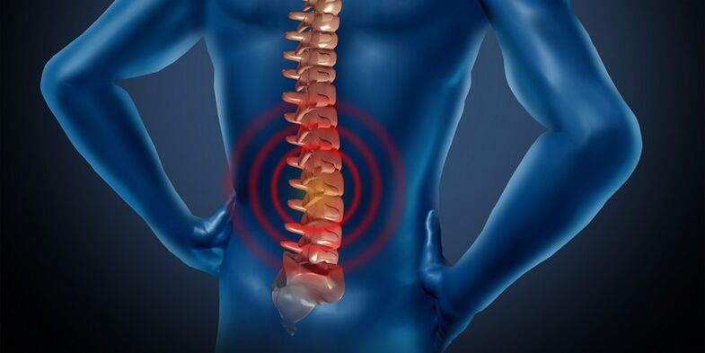 Osteocondrosis de la región lumbar