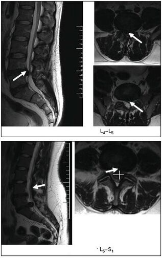 Imagen de resonancia magnética de una hernia de disco en la columna