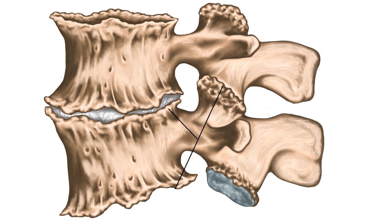 Lesiones espinales debido a la osteocondrosis.