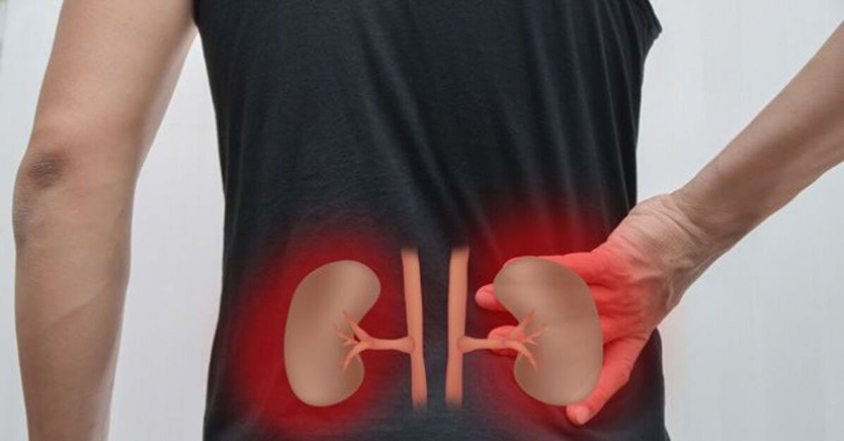 La inflamación de los riñones puede causar dolor lumbar.
