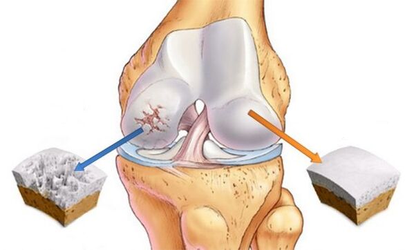 Osteoartritis de la articulación de la rodilla (izquierda) y cartílago normal (derecha)