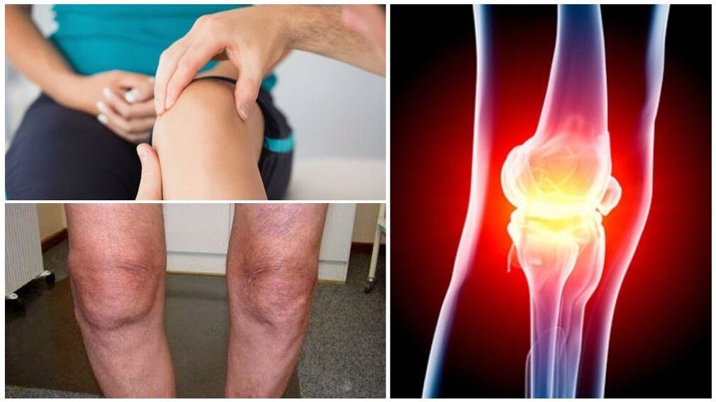 Síntomas de artrosis de la articulación de la rodilla.