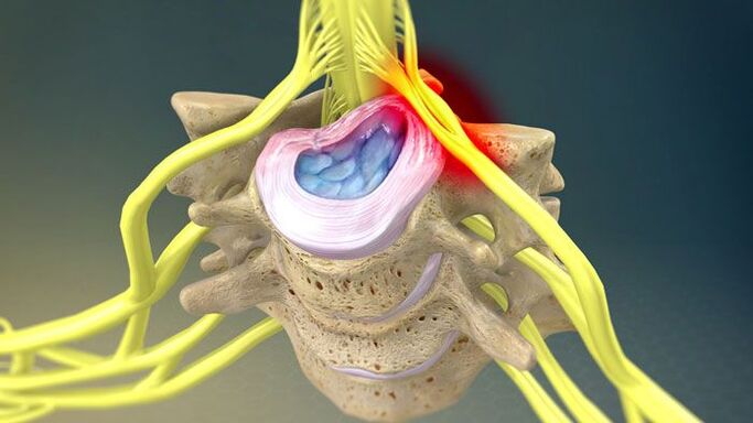 La protrusión del disco intervertebral causa dolor de cuello