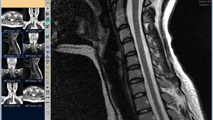 La resonancia magnética de la columna cervical es el mejor método para diagnosticar el dolor de cuello